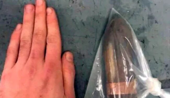 ¡Increíble!, veterano pasó años con una BOMBA incrustada en el RECTO