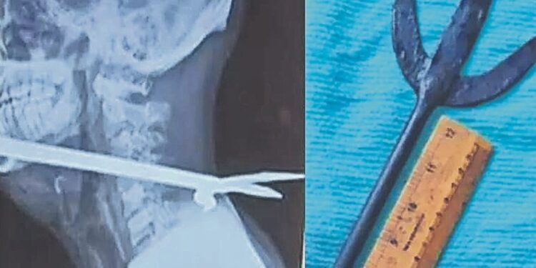 Tras pelea, le ENCAJAN tridente en la garganta pero ¡no siente dolor!