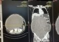 ¡Cuidadito!: ella creía que estaba “gordita”, pero tenía TUMOR de 20 kilos