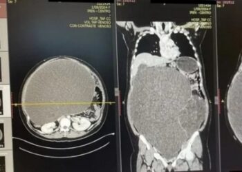 ¡Cuidadito!: ella creía que estaba “gordita”, pero tenía TUMOR de 20 kilos