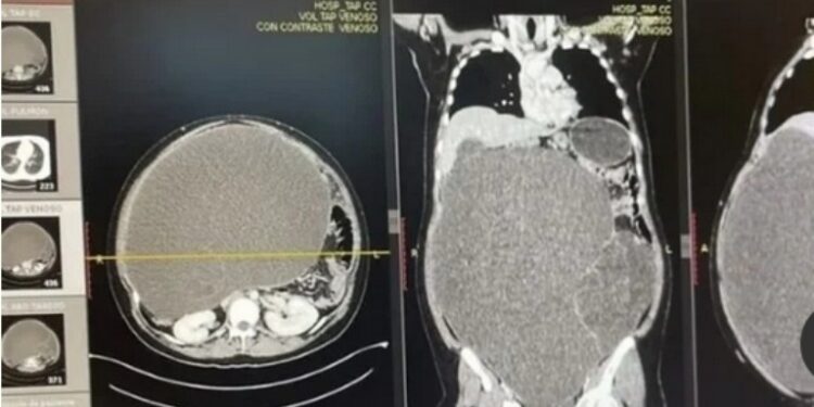 ¡Cuidadito!: ella creía que estaba “gordita”, pero tenía TUMOR de 20 kilos