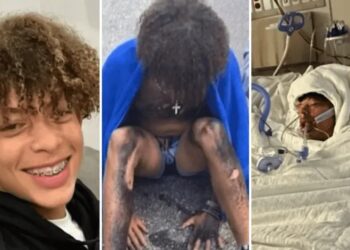 Por reto de TikTok adolescente sufre quemaduras en el 80% del cuerpo