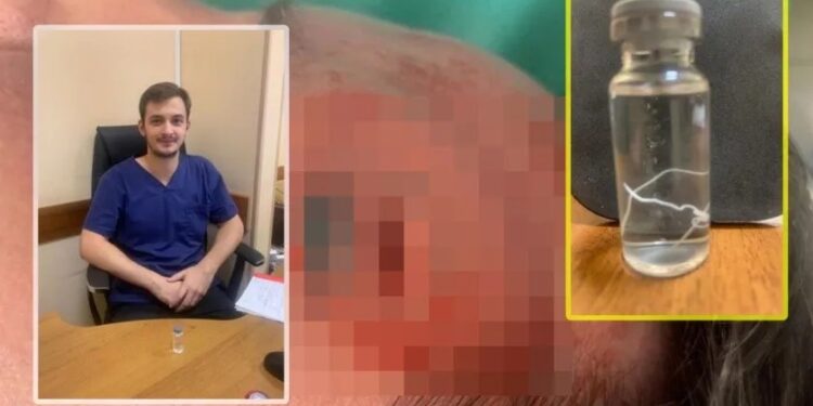 Sufría INSOPORTABLE dolor y le encuentran un GUSANO de 15 cm en la frente
