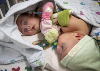 ¡Tras 18 horas de cirugía, BEBÉS SIAMESES son separados con ÉXITO!