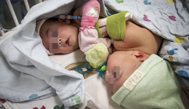 ¡Tras 18 horas de cirugía, BEBÉS SIAMESES son separados con ÉXITO!