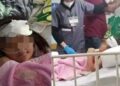 ¡NIÑA pasa 7 días con TIJERAS clavadas en la cabecita por no tener $ para la cirugía!