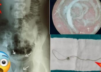 Joven se mete cable de 20 cm en el p*ne para “más placer” y ¡se le queda atorado!