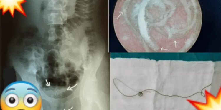Joven se mete cable de 20 cm en el p*ne para “más placer” y ¡se le queda atorado!
