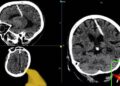 ¡Insólito!: ancianita tiene aguja clavada en el cerebro; padres intentaron matarla de bebé