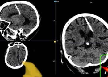 ¡Insólito!: ancianita tiene aguja clavada en el cerebro; padres intentaron matarla de bebé
