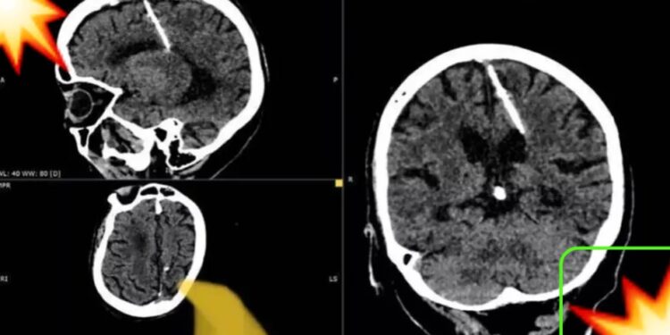 ¡Insólito!: ancianita tiene aguja clavada en el cerebro; padres intentaron matarla de bebé