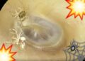 Video. Escuchaba “crujidos”, va al doctor y encuentran una araña viviendo en su oído